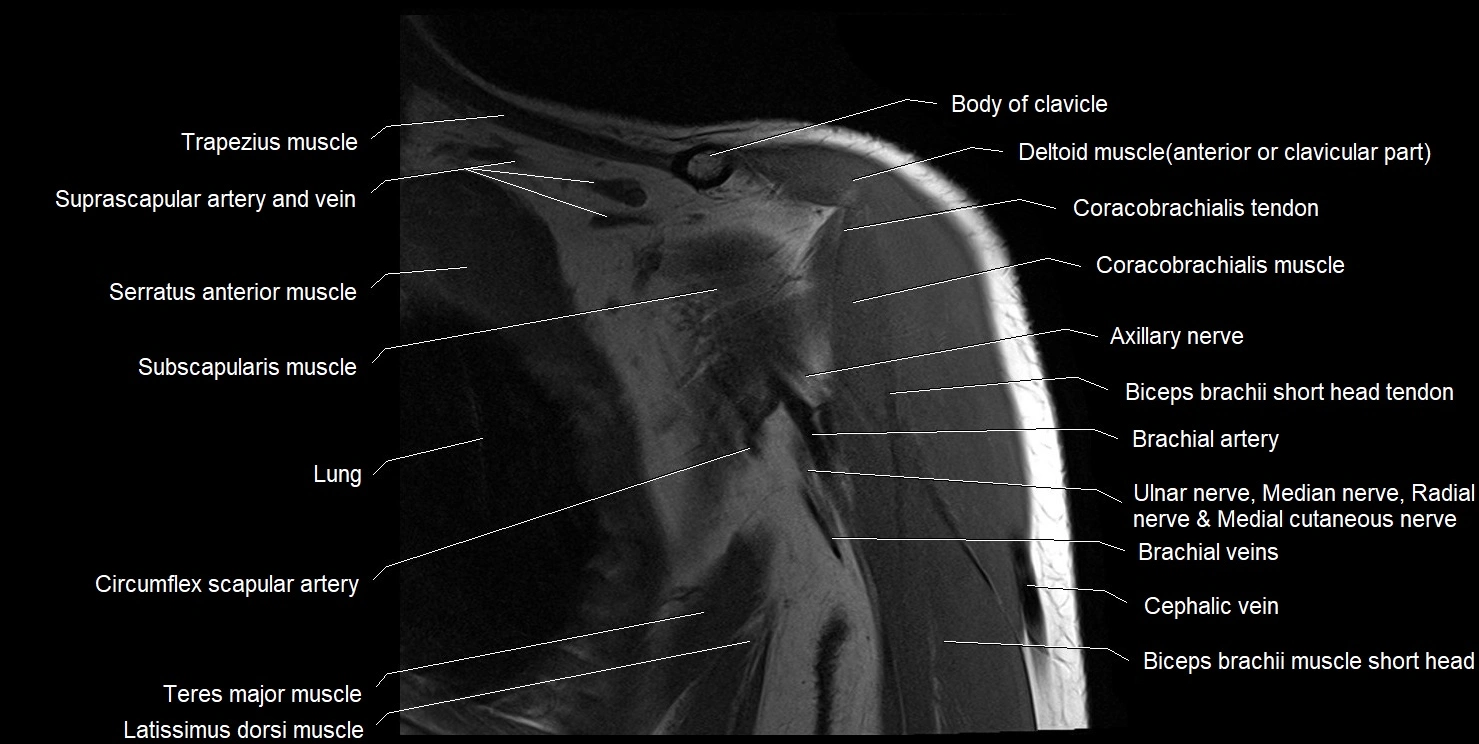 mri shoulder coronal cross sectional anatomy image 4.webp